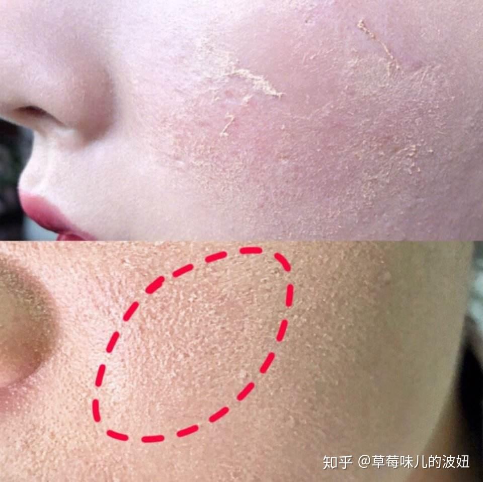 脸上皮肤干燥起皮怎么办?