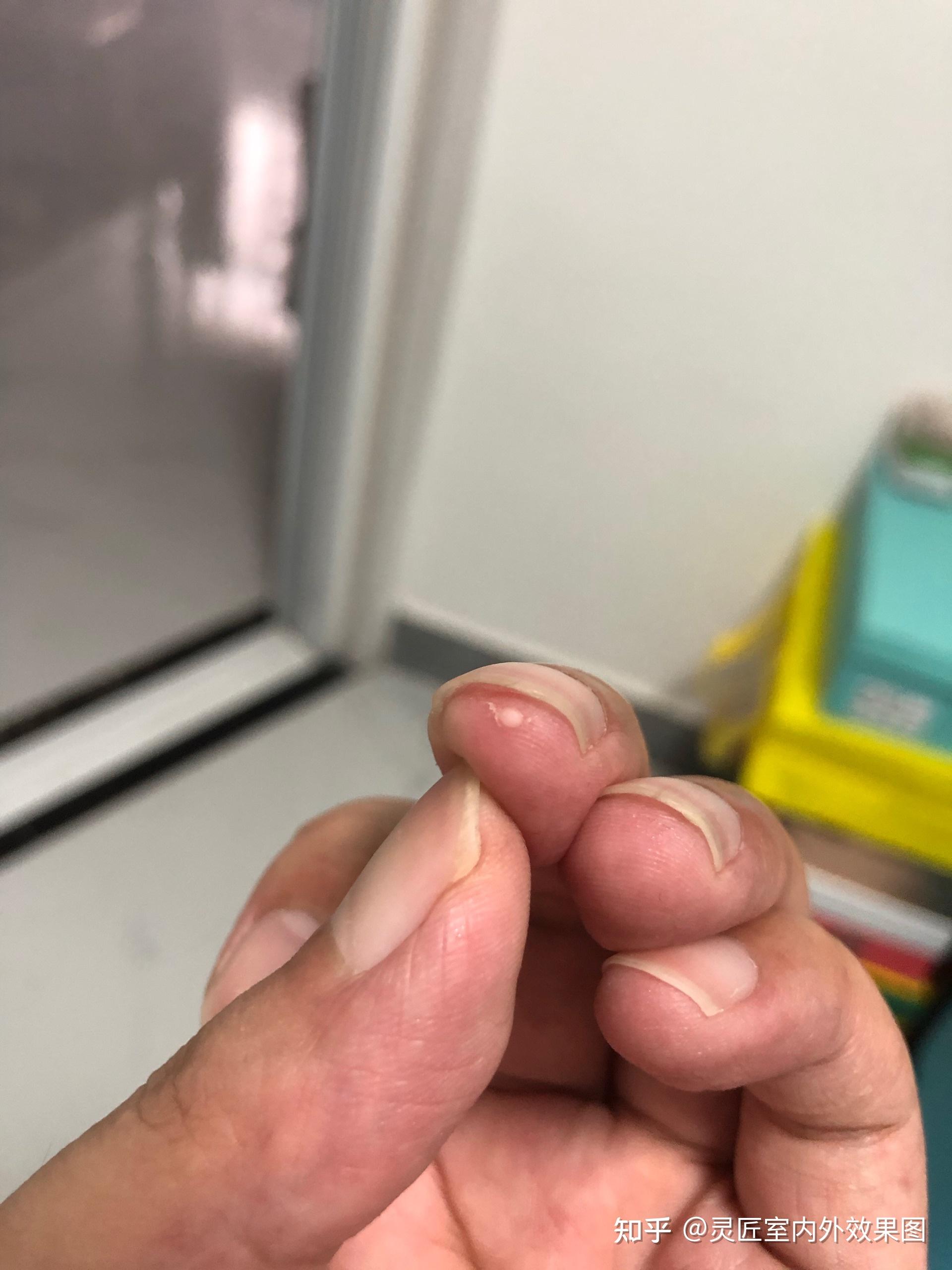 指甲尖部有一圈约1毫米宽呈白色