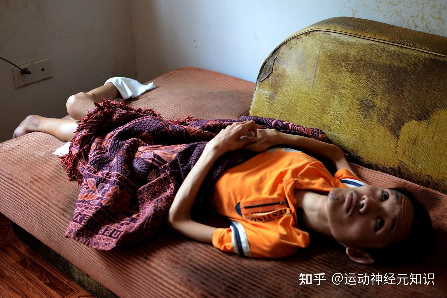 运动神经元病怎么致死告诉你其病7大危害