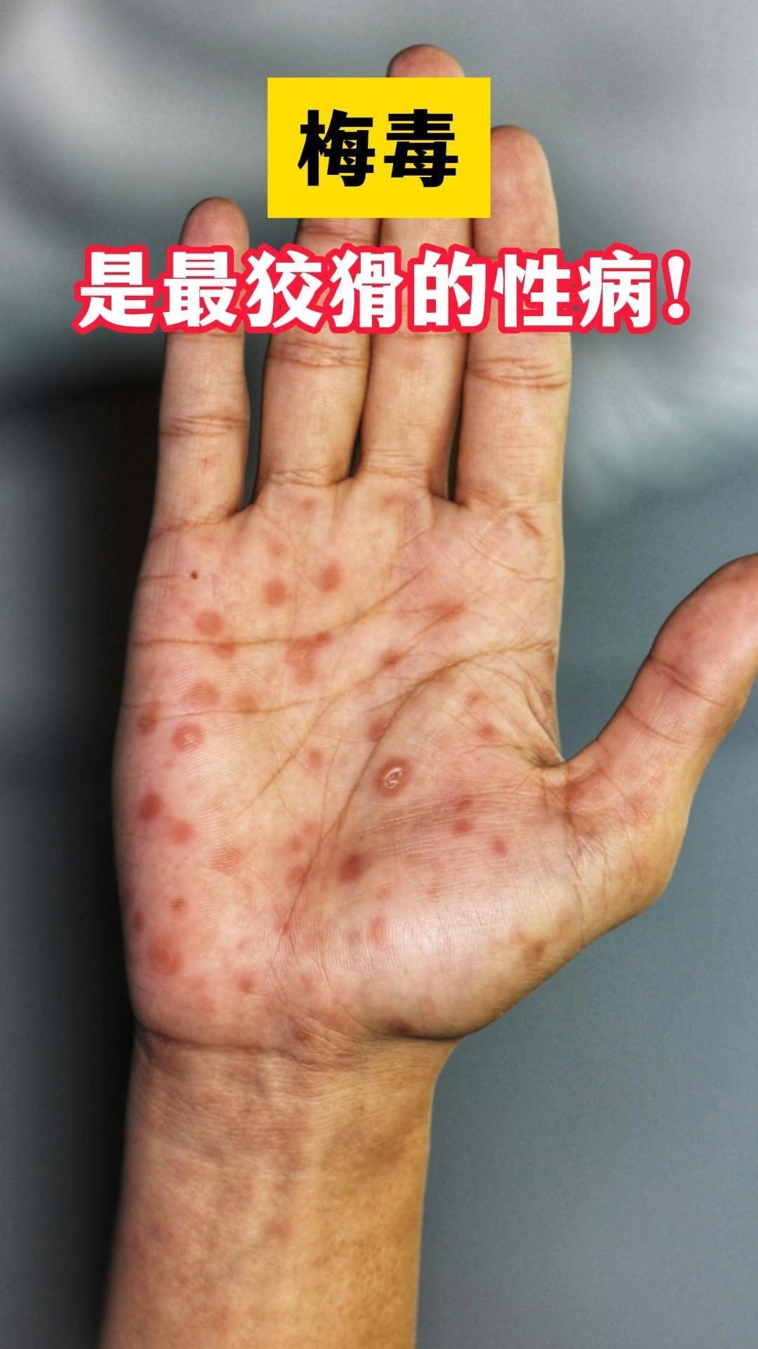 梅毒是什么样的?