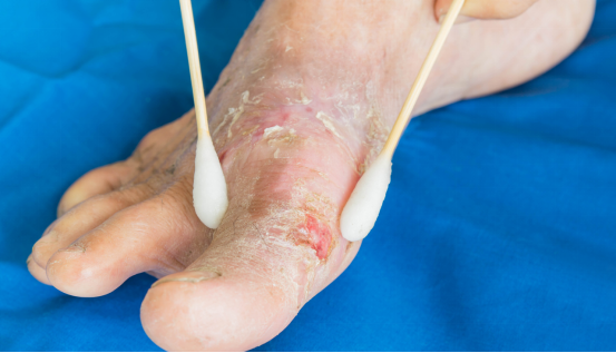 糖尿病足常见的症状有哪些? - 知乎