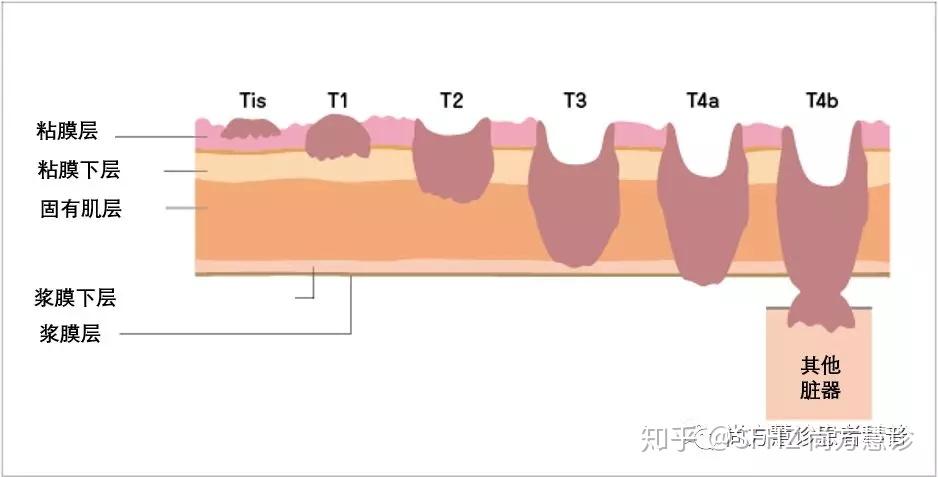 已长入粘膜下层(即结肠粘膜或结肠内壁下的组织层),但未浸润固有肌层