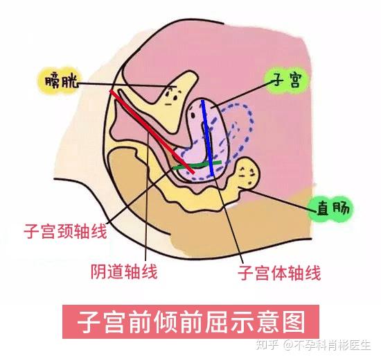 有些备孕妈妈可能要问了,为什么我的检查结果上面写的是"子宫前倾前屈