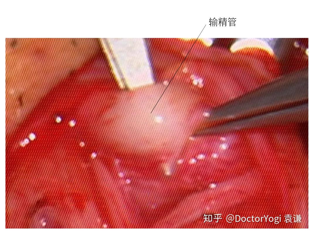 的"生命线",里面不仅有供应睾丸的血管,也有将精子运出睾丸的输精管