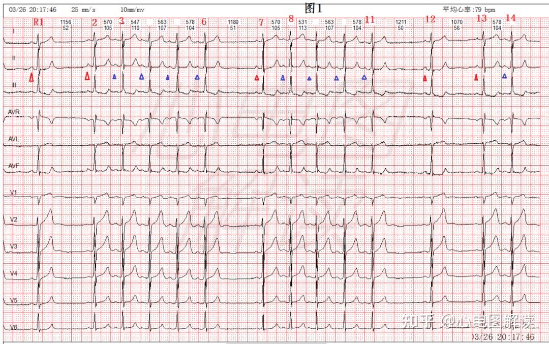 图1心电图分析 红色标记的p波在i