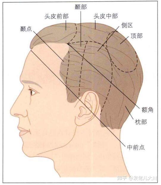 有没有客观一点的植发体验