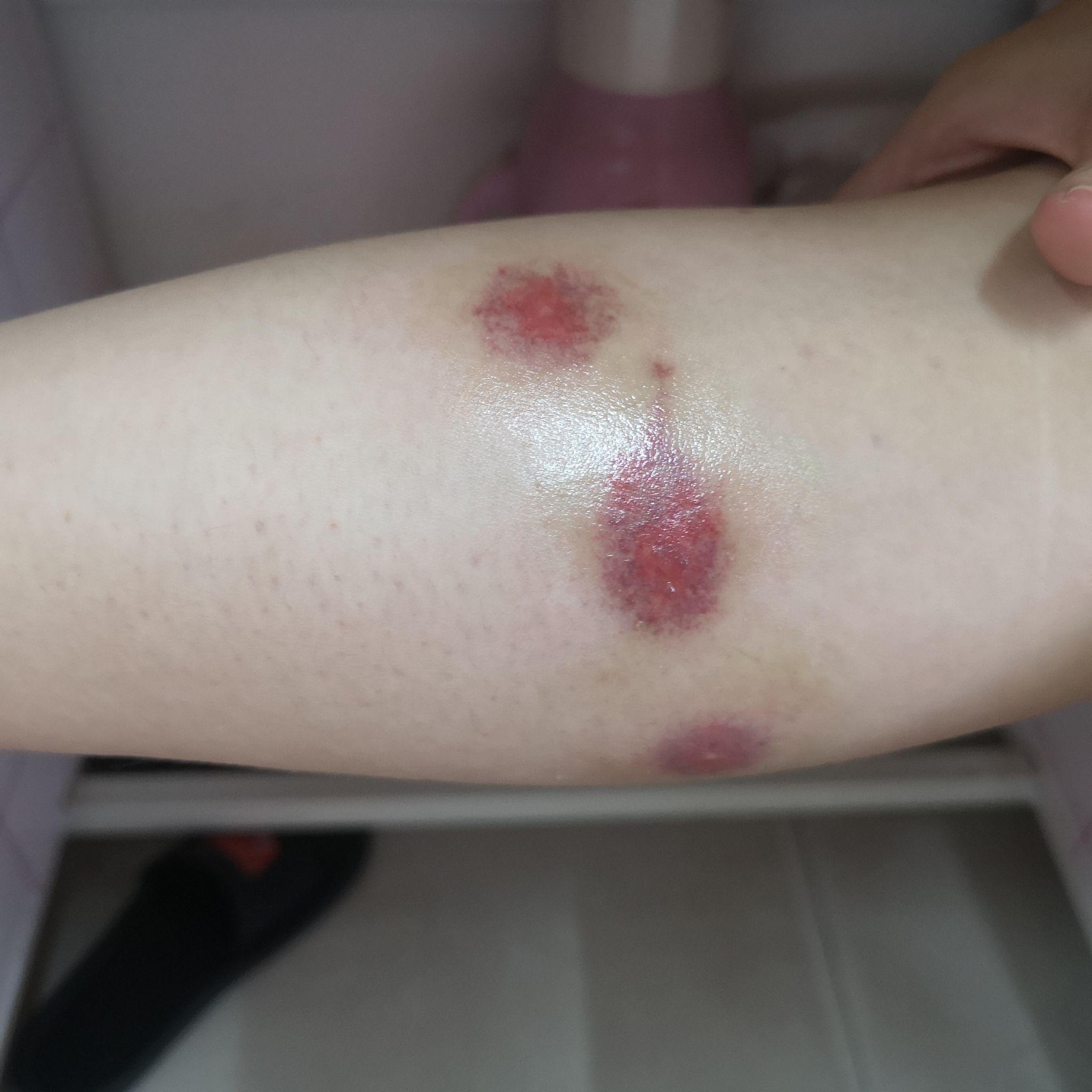 被毒蚊子咬后如何快速消肿止痒