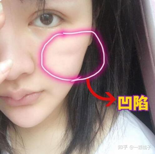 锯齿线原理及手术过程