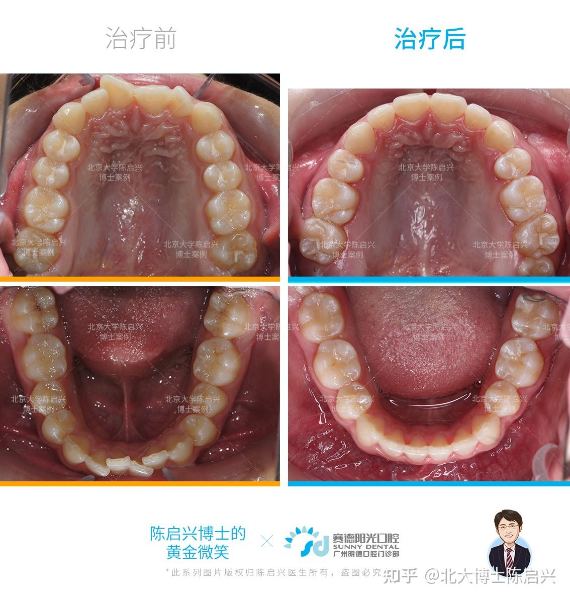 牙齒擁擠 門牙扭轉 深覆合露齦笑矯正案例 - 知乎