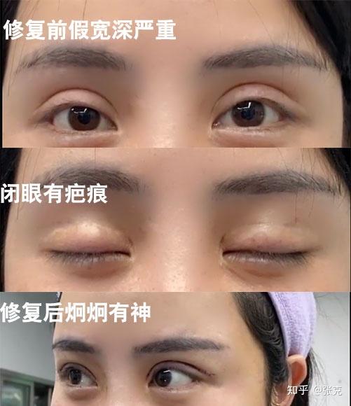 如何区分双眼皮真性肉条和假性肉条71