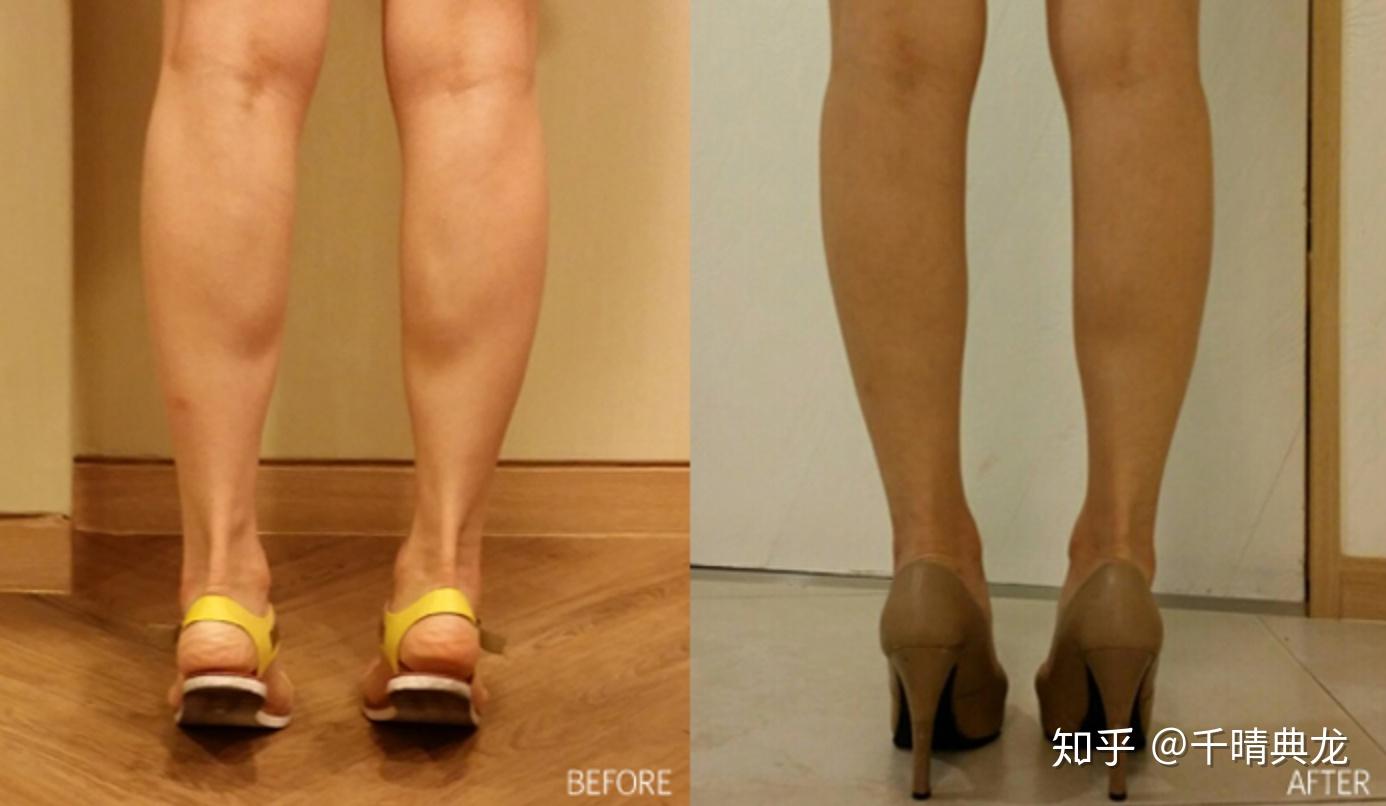 「女明星腿精大赏」o型腿是如何蜕变成美腿的？_小腿