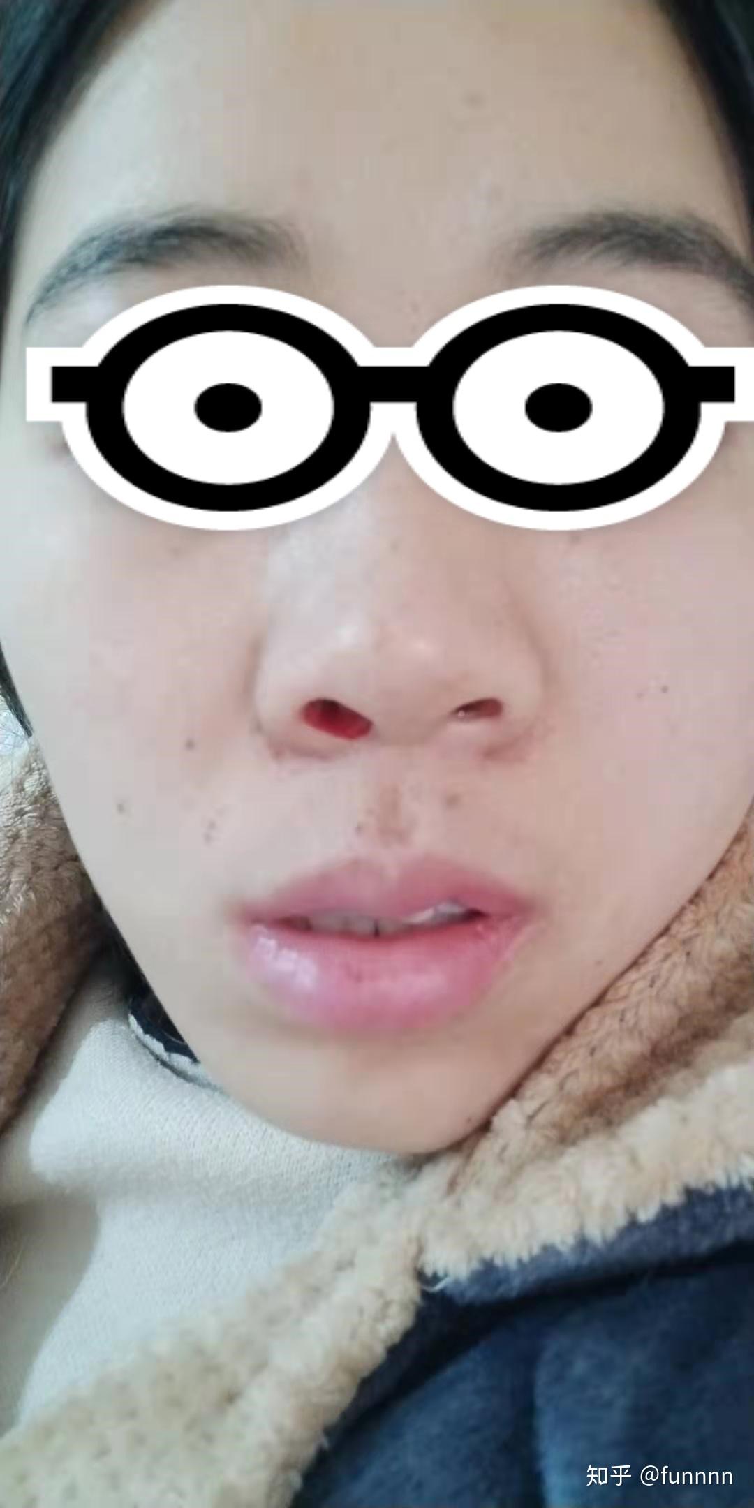 记录二十七年第一次手术鼻息肉鼻窦炎手术