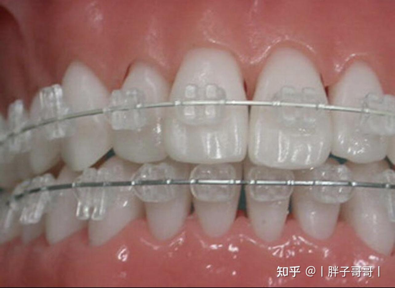 正畸推荐自锁还是陶瓷呢