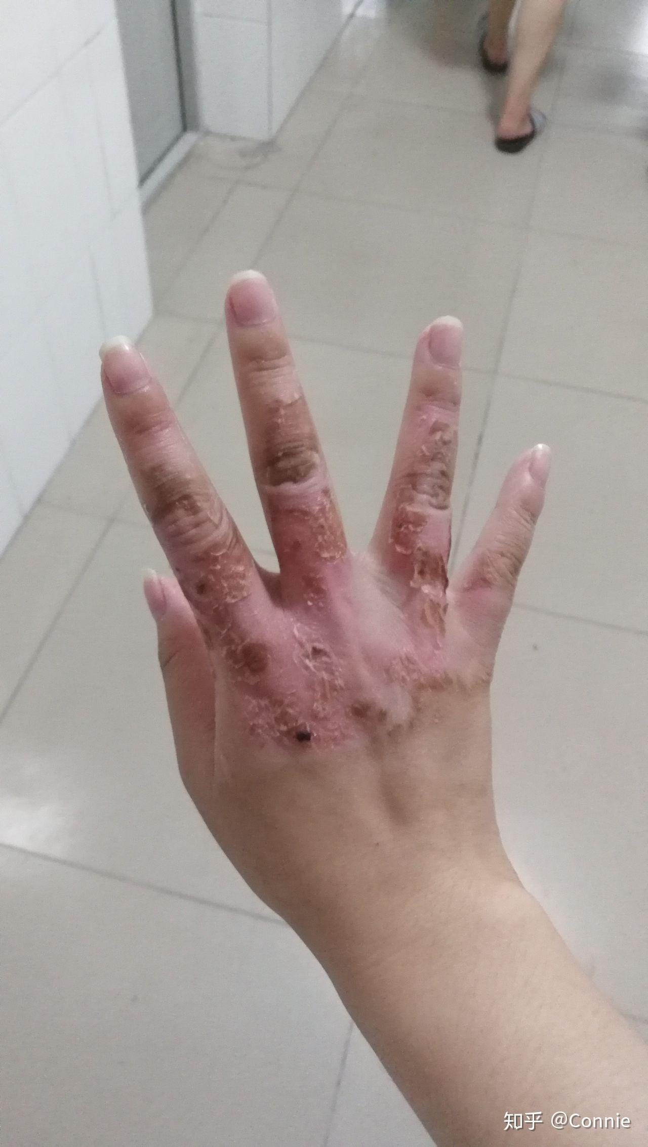 手被开水烫伤了怎么办