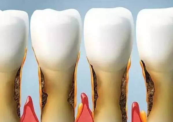 "根面龋"有多恐怖?一辈子都不想经历.