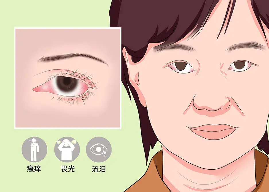 春季那些难缠的眼病最后一种还会致盲