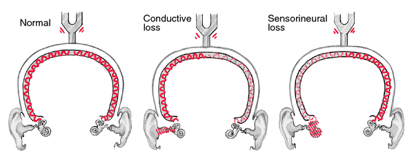 rinne test sensorineural hearing loss