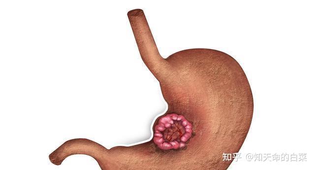 冬季是胃病的高发期,脾胃虚寒该怎么办? - 知乎