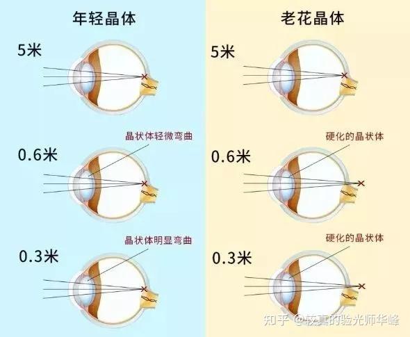 如果把睫狀肌想象成彈簧,兒童的眼睛配備了剛出廠,彈性十足的睫狀肌.