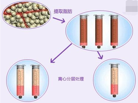 颜色,纤维等方面是有差异的,所以溶脂要根据脂肪情况确定不同的溶解