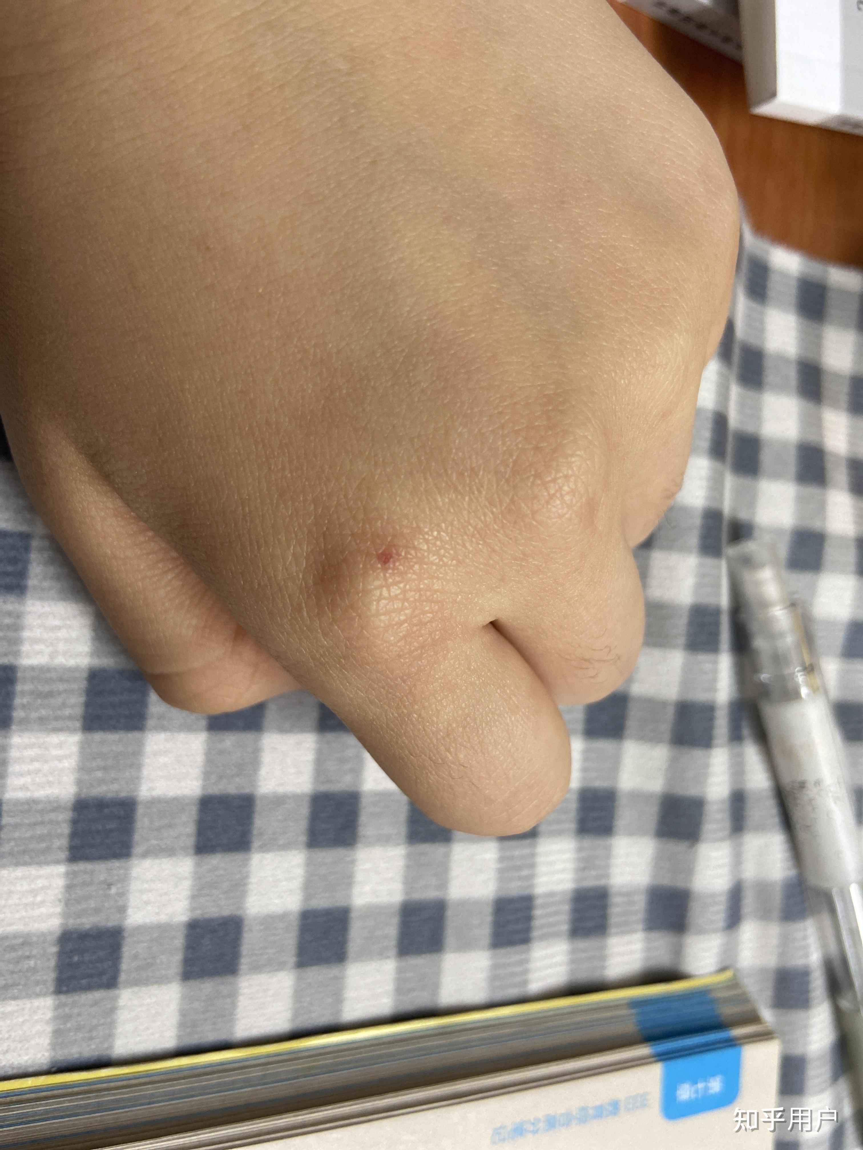 手指上长了一个针眼大的小红点感觉像血管一按就消失松开就又出现了