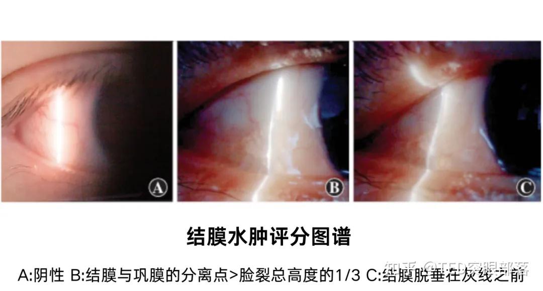 如何判断甲状腺眼病是否在活动期？图谱对照版来了！（自测版） - 知乎