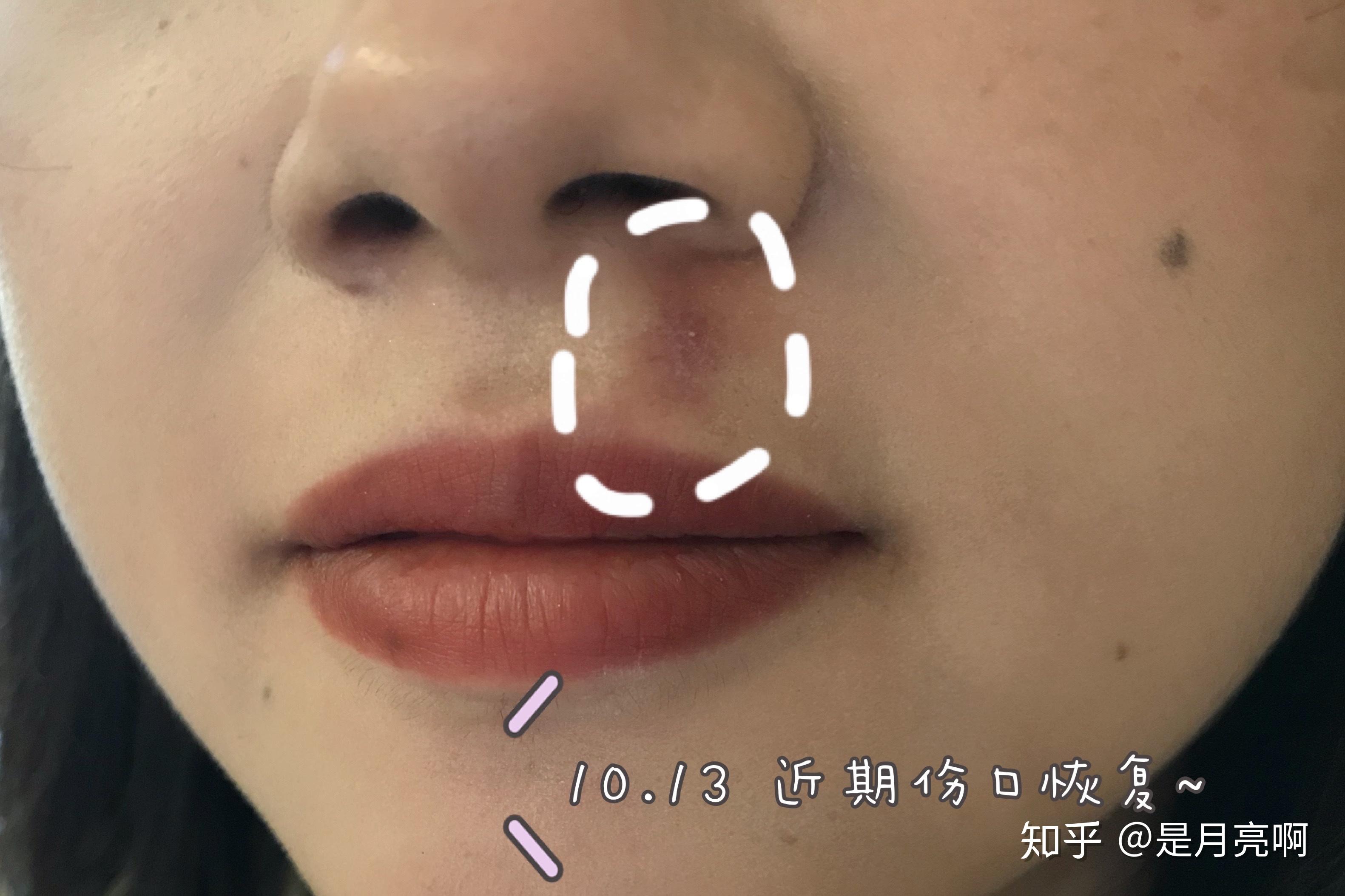 口唇の形成 | 奈良 樹のひかり形成外科・皮ふ科