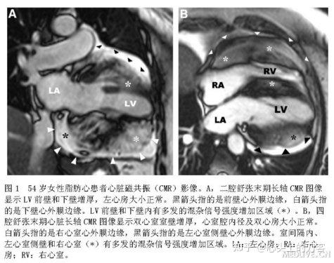 罕见心脏病脂肪心