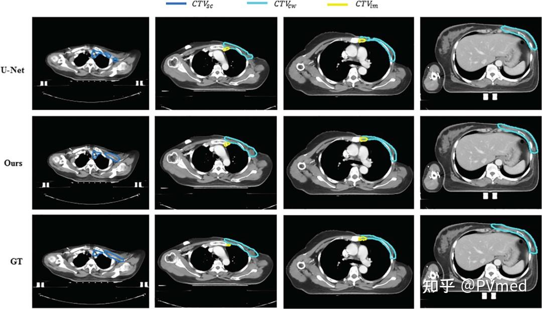 柏视医疗联合天肿团队完成乳腺癌改良根治术后的放疗靶区自动勾画 知乎