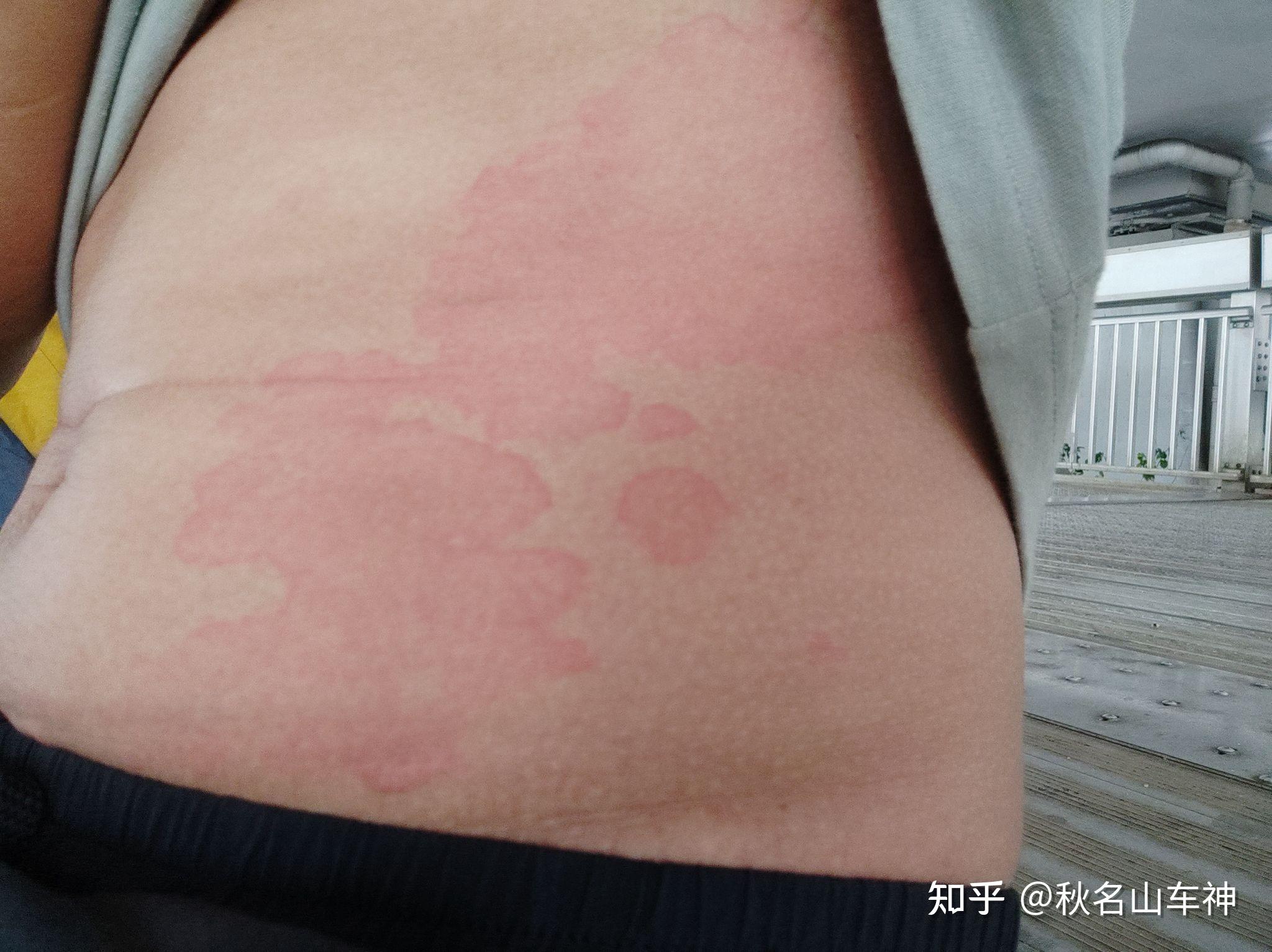 这是过敏还是什么啊 - 知乎