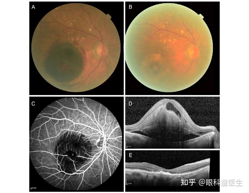视网膜血管性疾病——6,获得性视网膜大动脉瘤