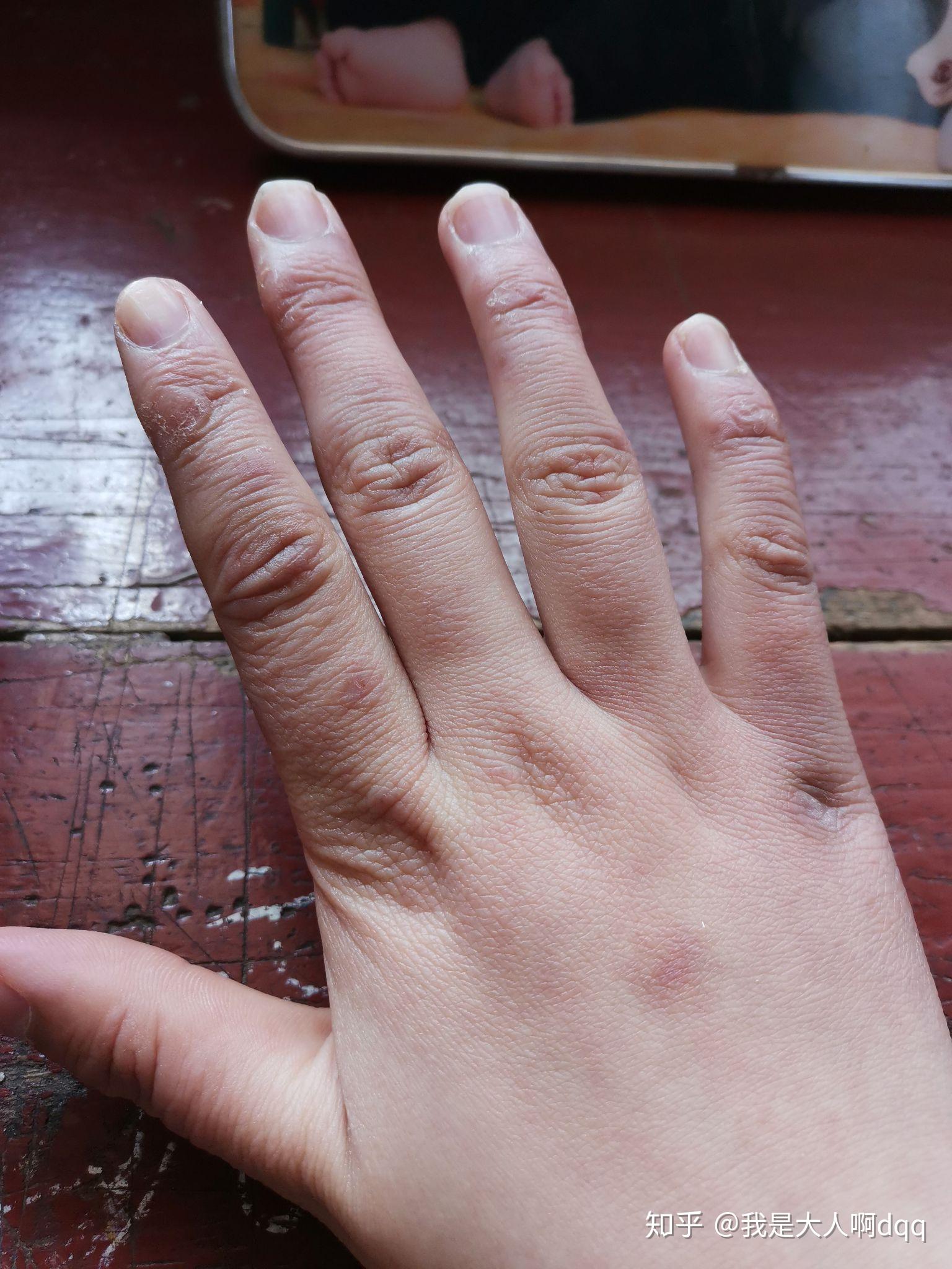 一双10多年的冻疮手好难看