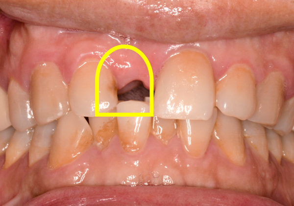 为什么会牙缝大有哪些危害牙齿稀疏牙缝太大不好看到底要不要解决