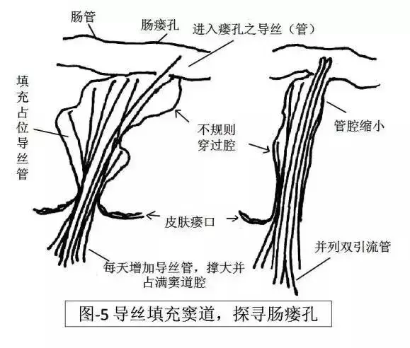 怎么确定窦道图片