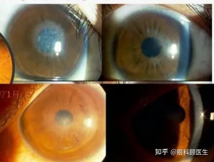 表层角膜激光术后haze的成因与治疗