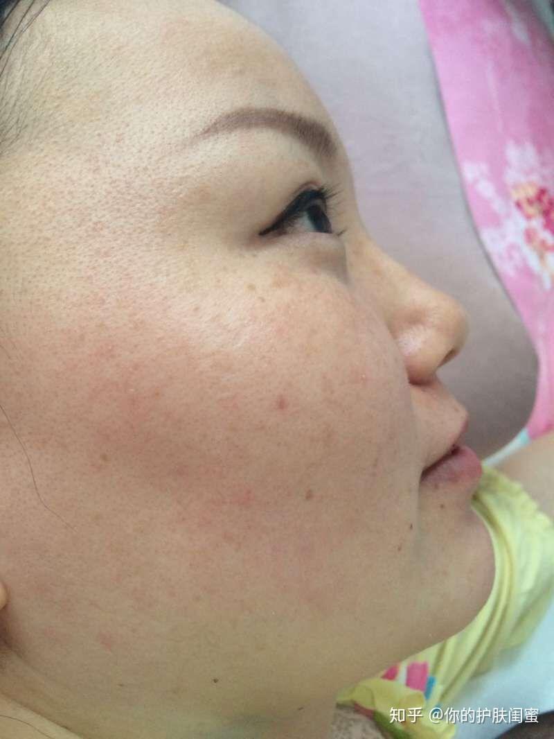 皮肤脆弱用什么产品能彻底变好用真实案例为你解答