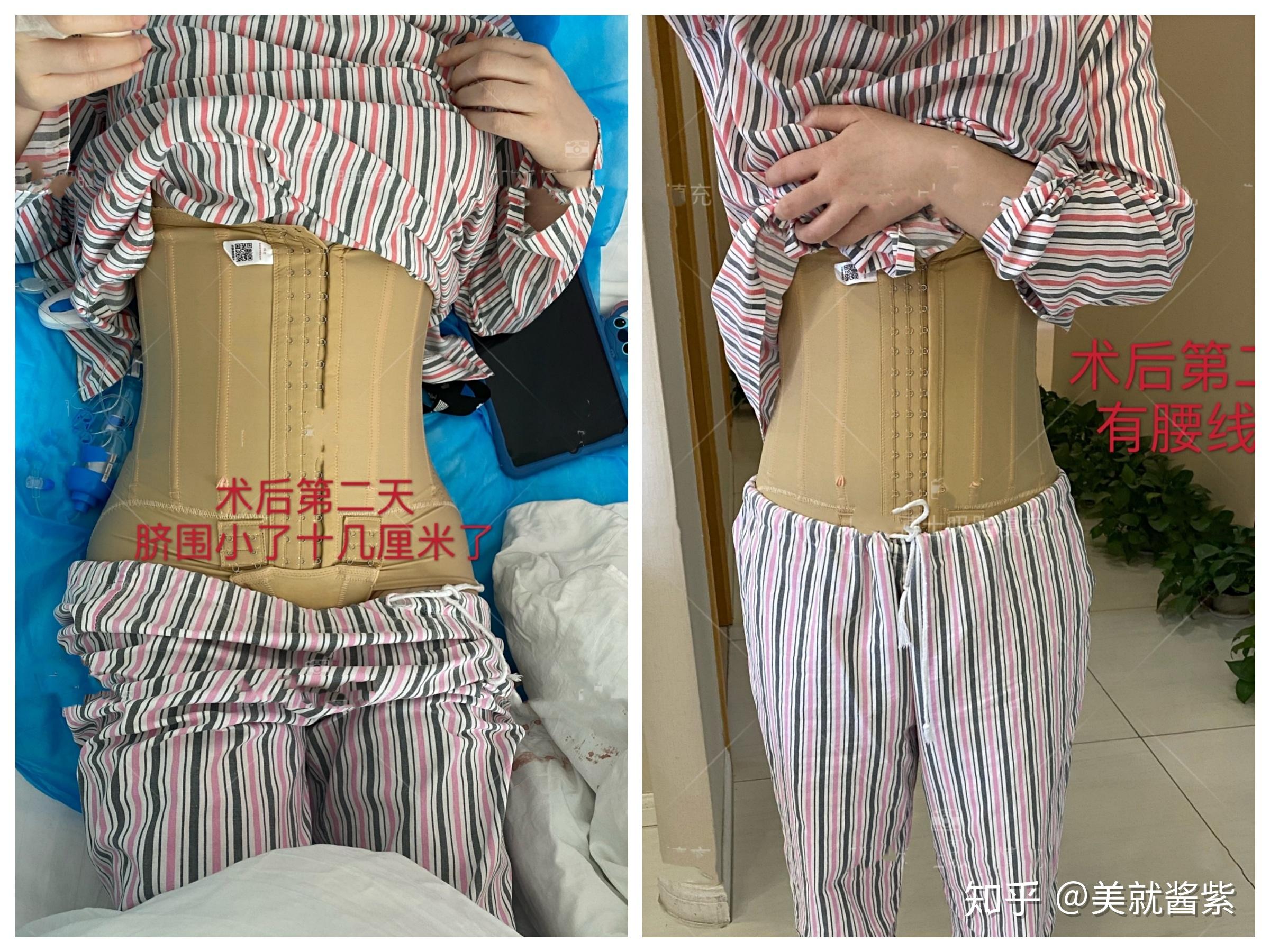 南京吸脂哪个医生好呢求推荐大腿环吸腹部小腿吸脂