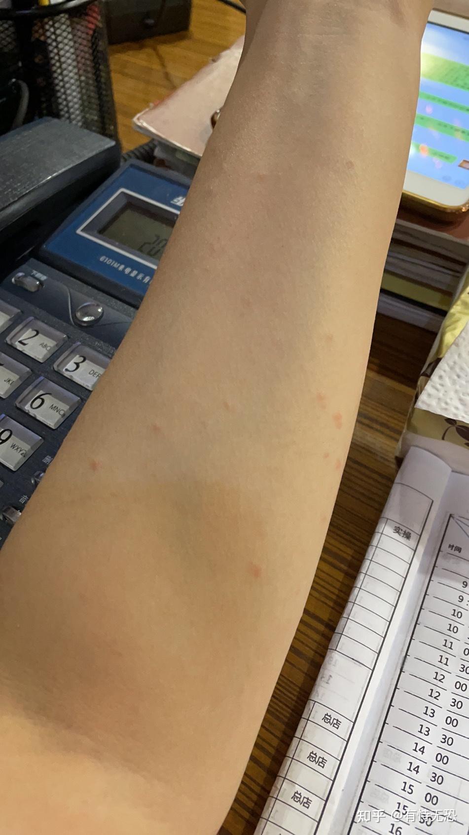 被玫瑰糠疹折磨的第19天