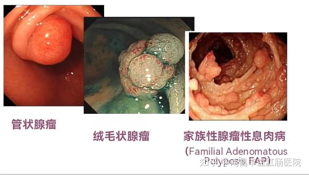 出现哪些症状,需警惕肠道肿瘤?