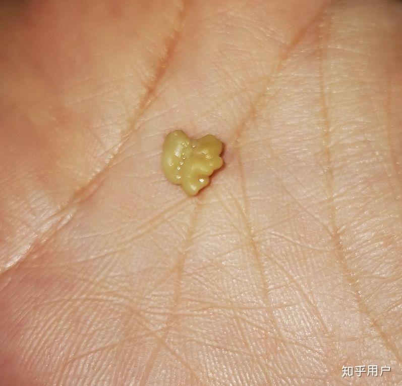 你见过最大的扁桃体结石有多大