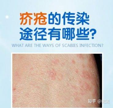 疥疮的传染途径有哪些? - 知乎