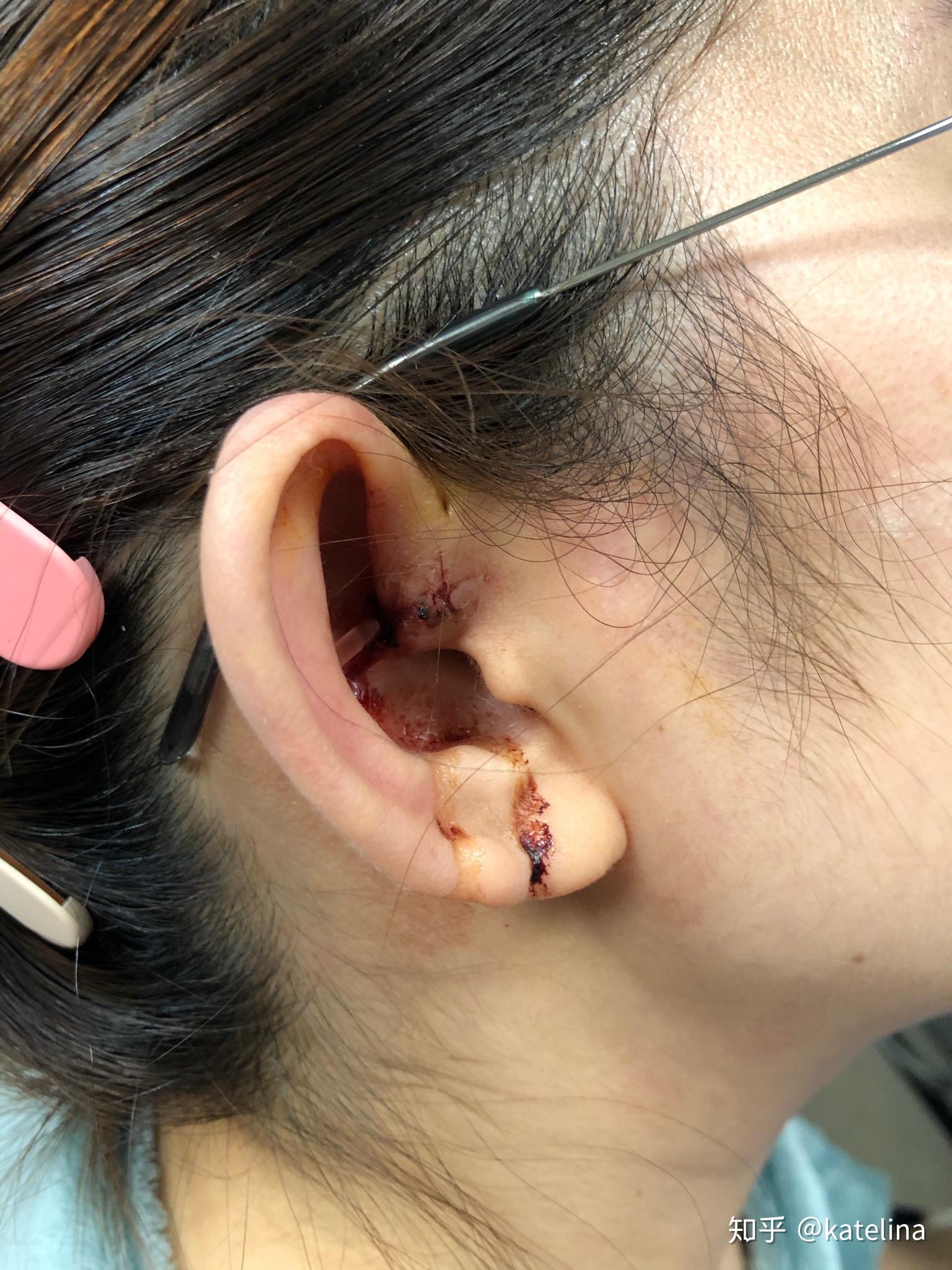 患有先天性耳前瘘管是一种怎样的体验? 