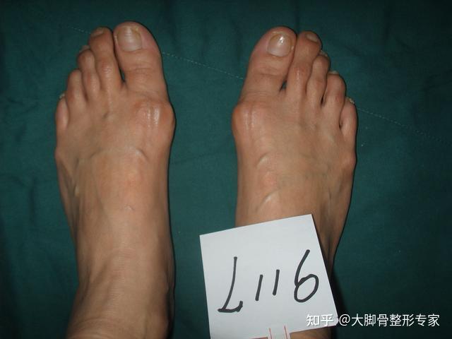 哪些大脚骨会快速发展拇外翻