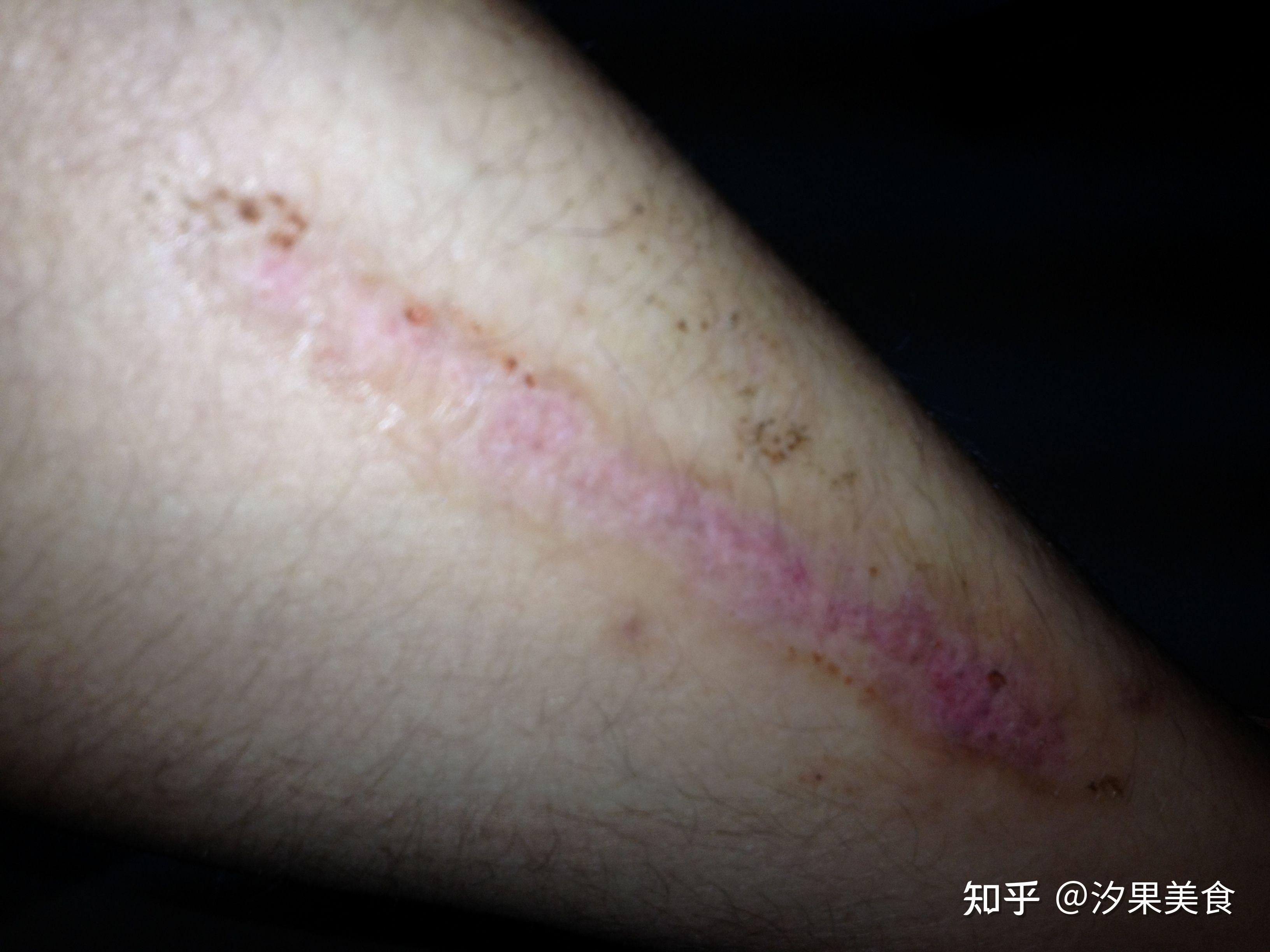 擦伤的疤痕多久可以好? - 知乎