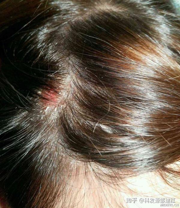 解决头皮瘙痒 头屑多问题看这篇文章就够了 头皮痒头屑多有可能传染吗 五品网