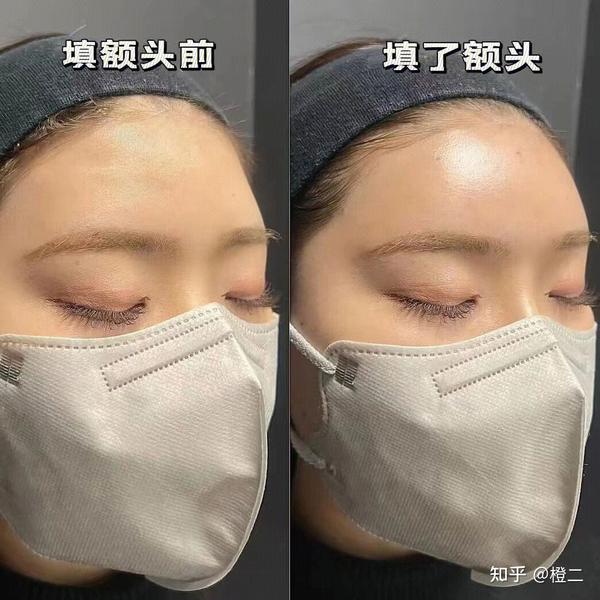 额头填充美商指南|什么样的额头才最好看？为什么露额头的都是大美女？ - 知乎