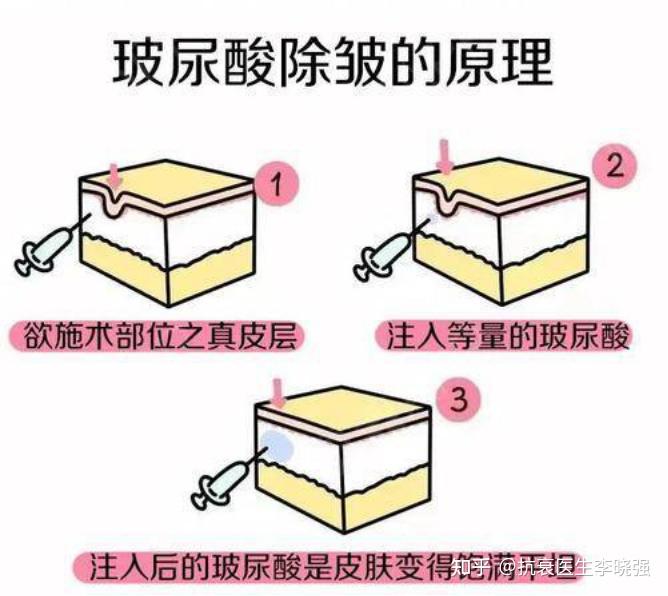 1,肉毒素除皱原理肉毒素,是肉毒杆菌中所得出的一种天然纯化蛋白质