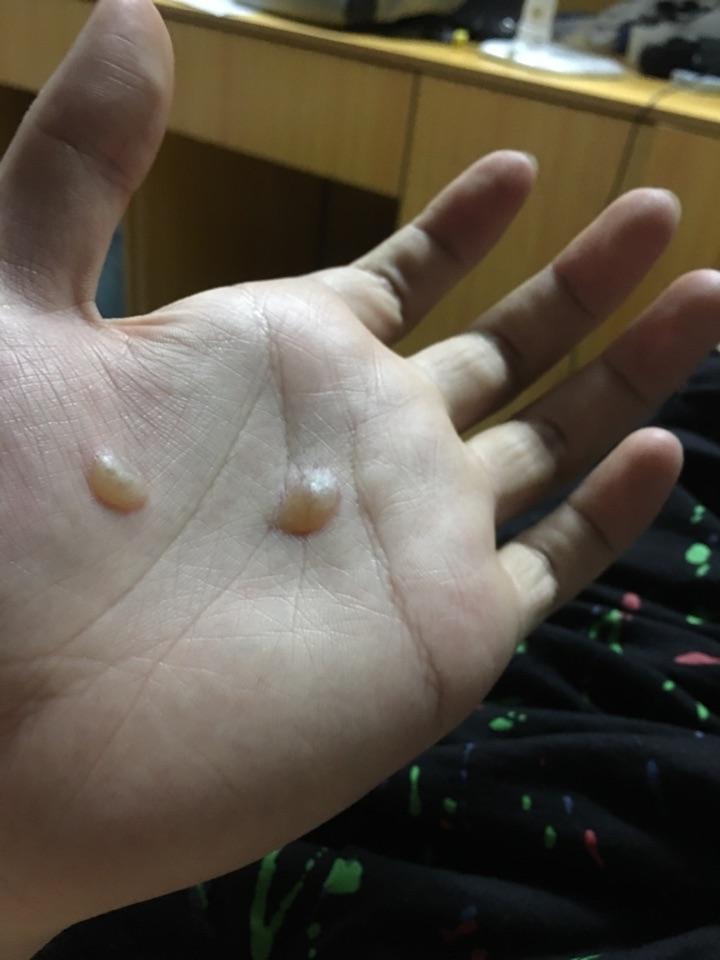 烟头烫在身上是怎样的