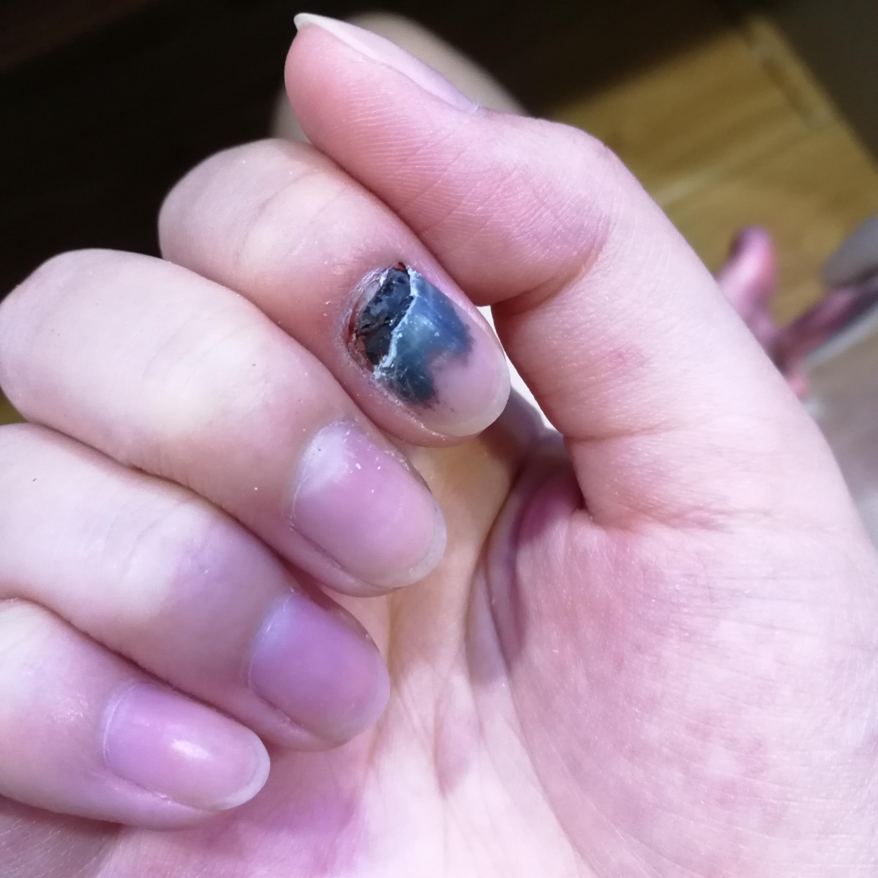 手指被门夹了,然后指甲里面四分之一有淤血,都两个月了还没好,怎么办?