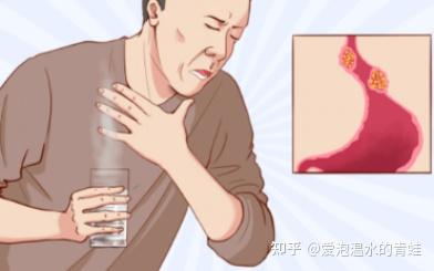 反流性食管炎到底怎么治？老反酸、烧心的人一定要看 - 知乎